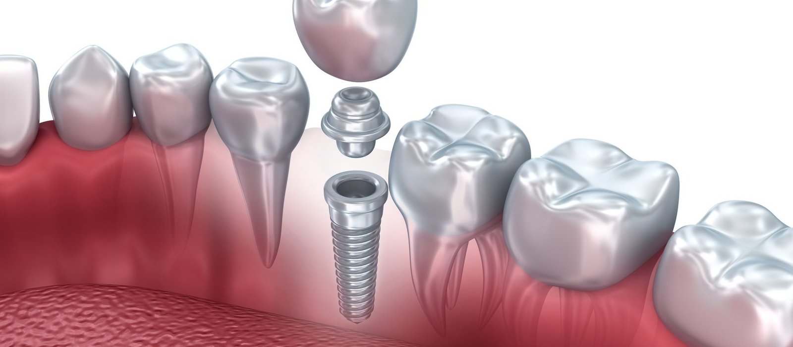 Cuidados com o implante dentário